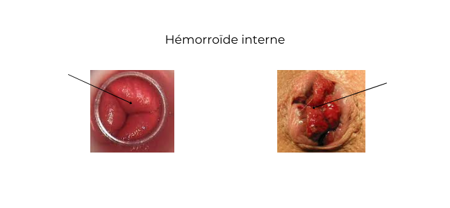 Hémorroïdes internes - Coloproctologie