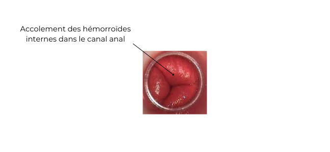 Hémorroïdes internes - Coloproctologie