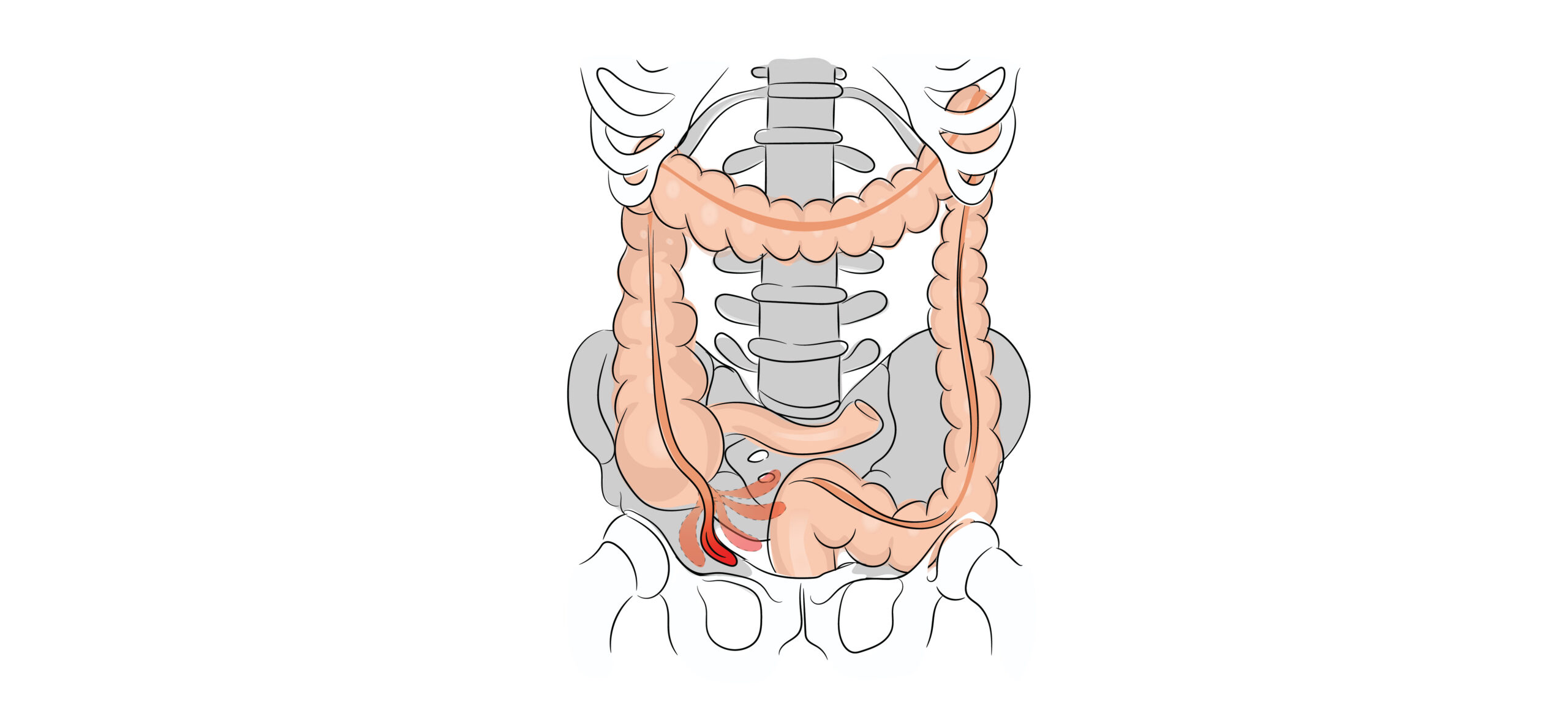 https://coloproctologie.com/wp-content/uploads/2022/03/Appendicectomie-04-1-scaled.jpeg