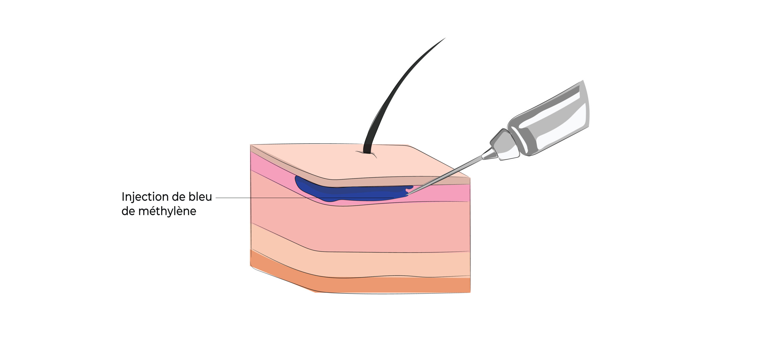 https://coloproctologie.com/wp-content/uploads/2022/03/Appendicectomie-06-scaled.jpeg