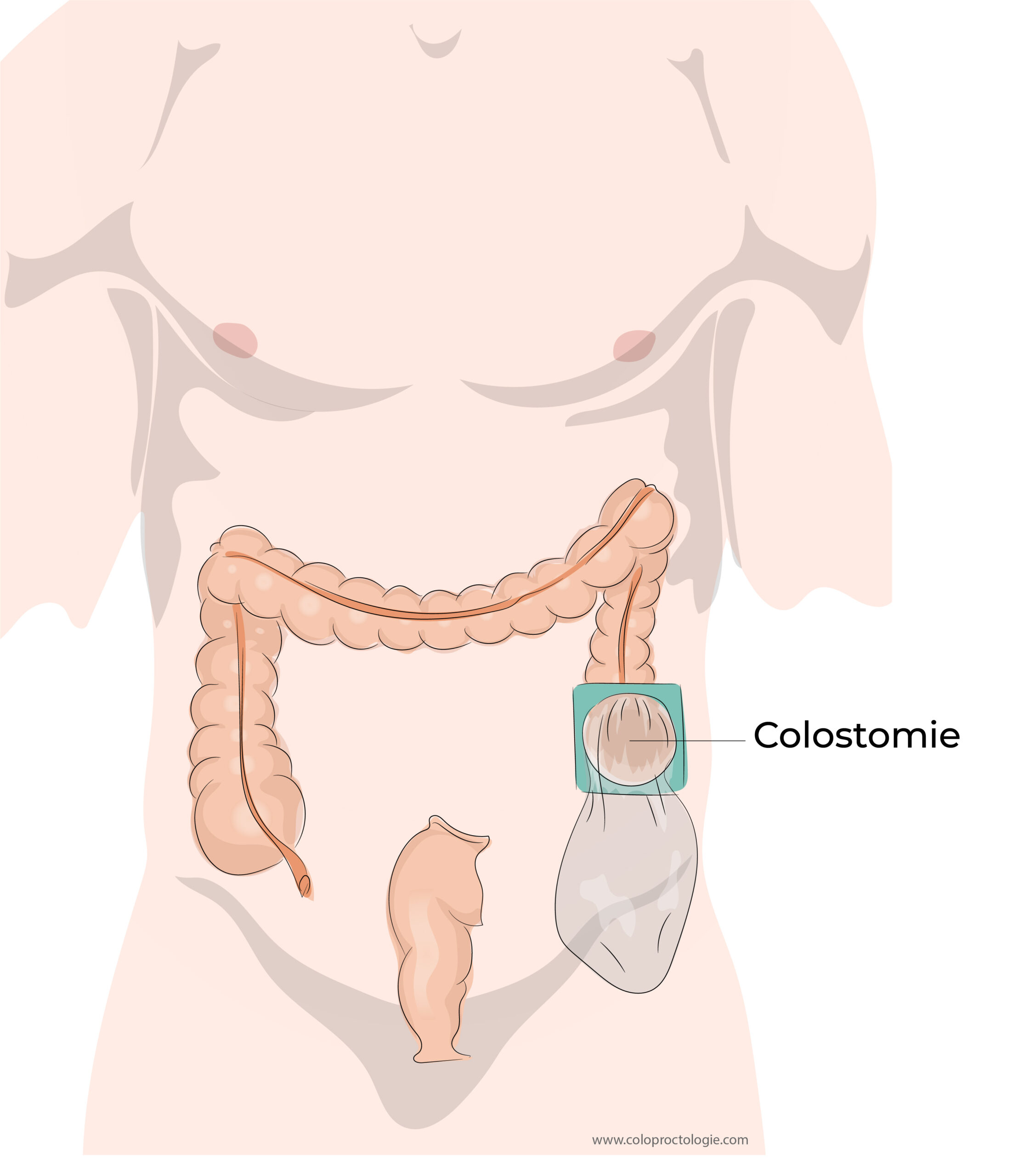 Colectomie droite - Coloproctologie