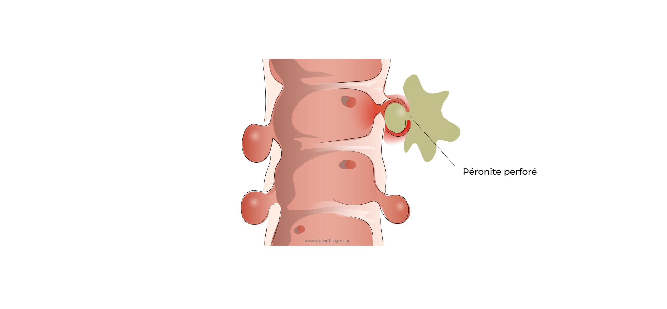 https://coloproctologie.com/wp-content/uploads/2022/03/Diverticulite-aigue-20-scaled.jpeg