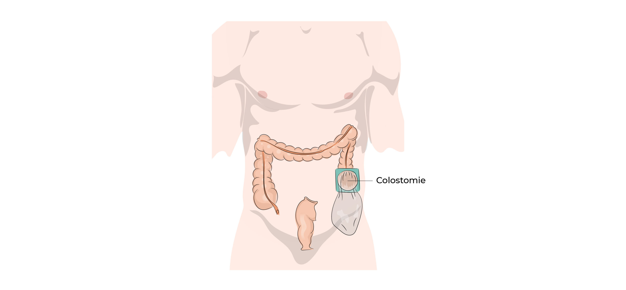 https://coloproctologie.com/wp-content/uploads/2022/03/Diverticulite-aigue-24-scaled.jpeg