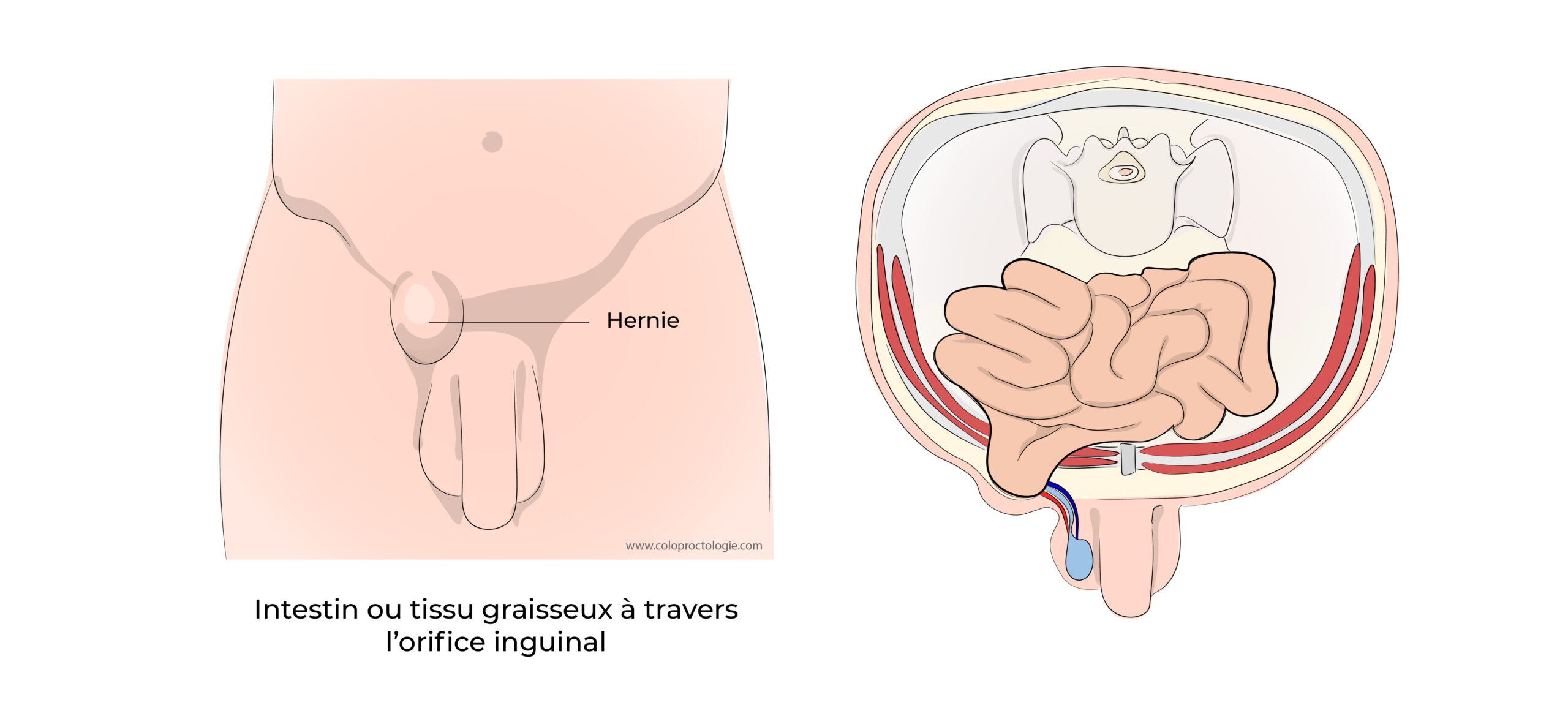 https://coloproctologie.com/wp-content/uploads/2022/03/Hernie-Inguinales-Illustrations-18-scaled.jpeg