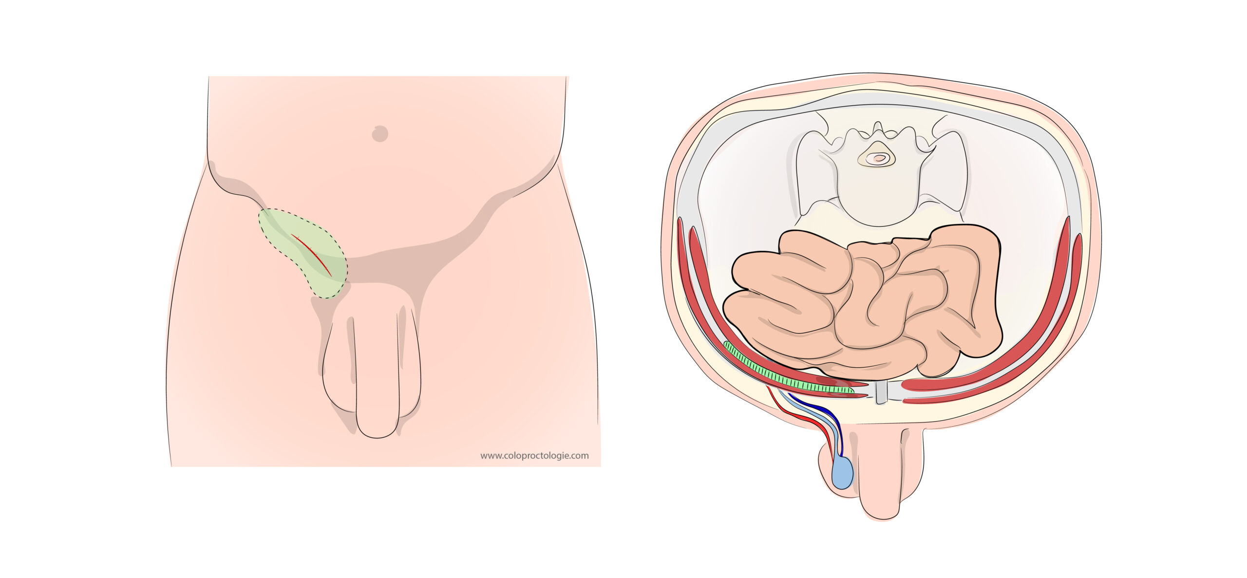 https://coloproctologie.com/wp-content/uploads/2022/03/Hernie-Inguinales-Illustrations-19-scaled.jpeg