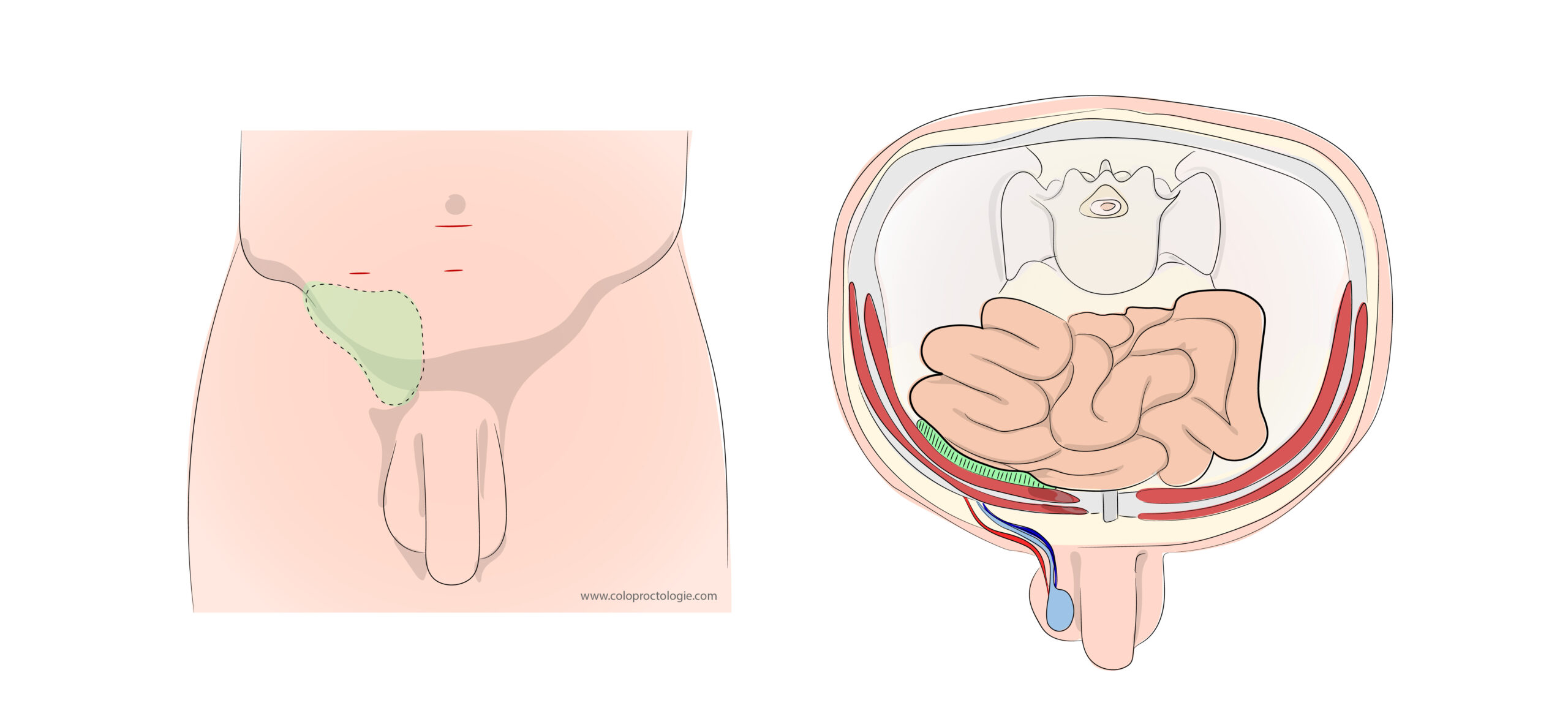 Inguinal hernia - Coloproctologie