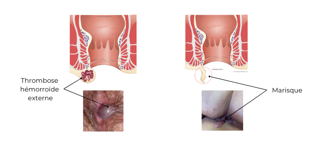 https://coloproctologie.com/wp-content/uploads/2022/03/Hémorroide-externe-marisque.png