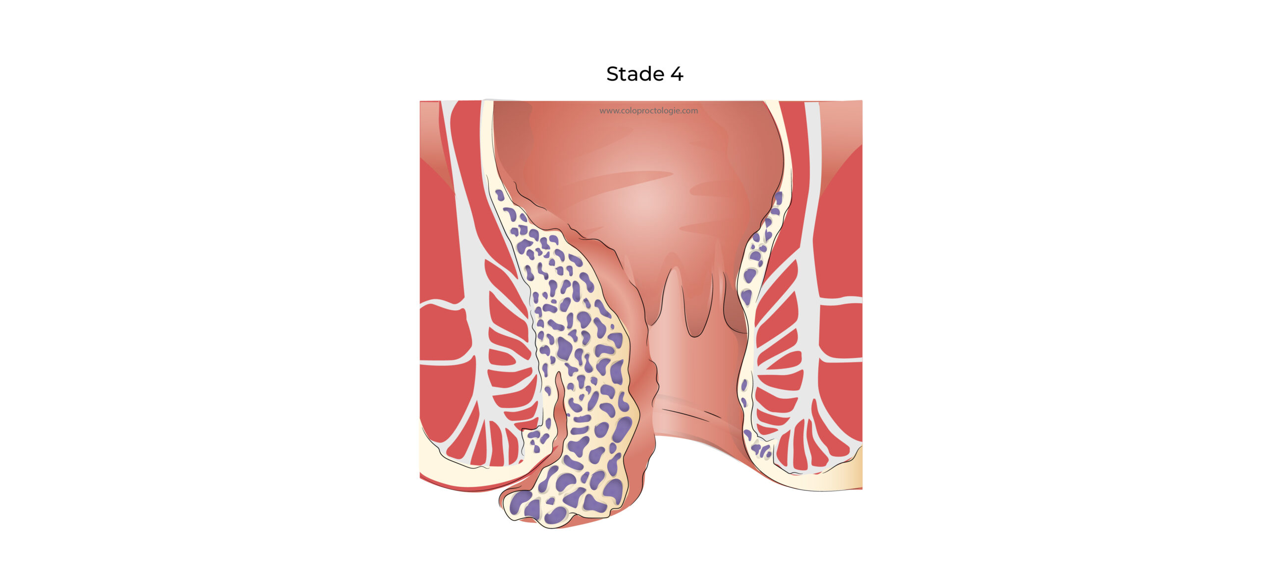 https://coloproctologie.com/wp-content/uploads/2022/03/Hémorroïde-20-scaled.jpg