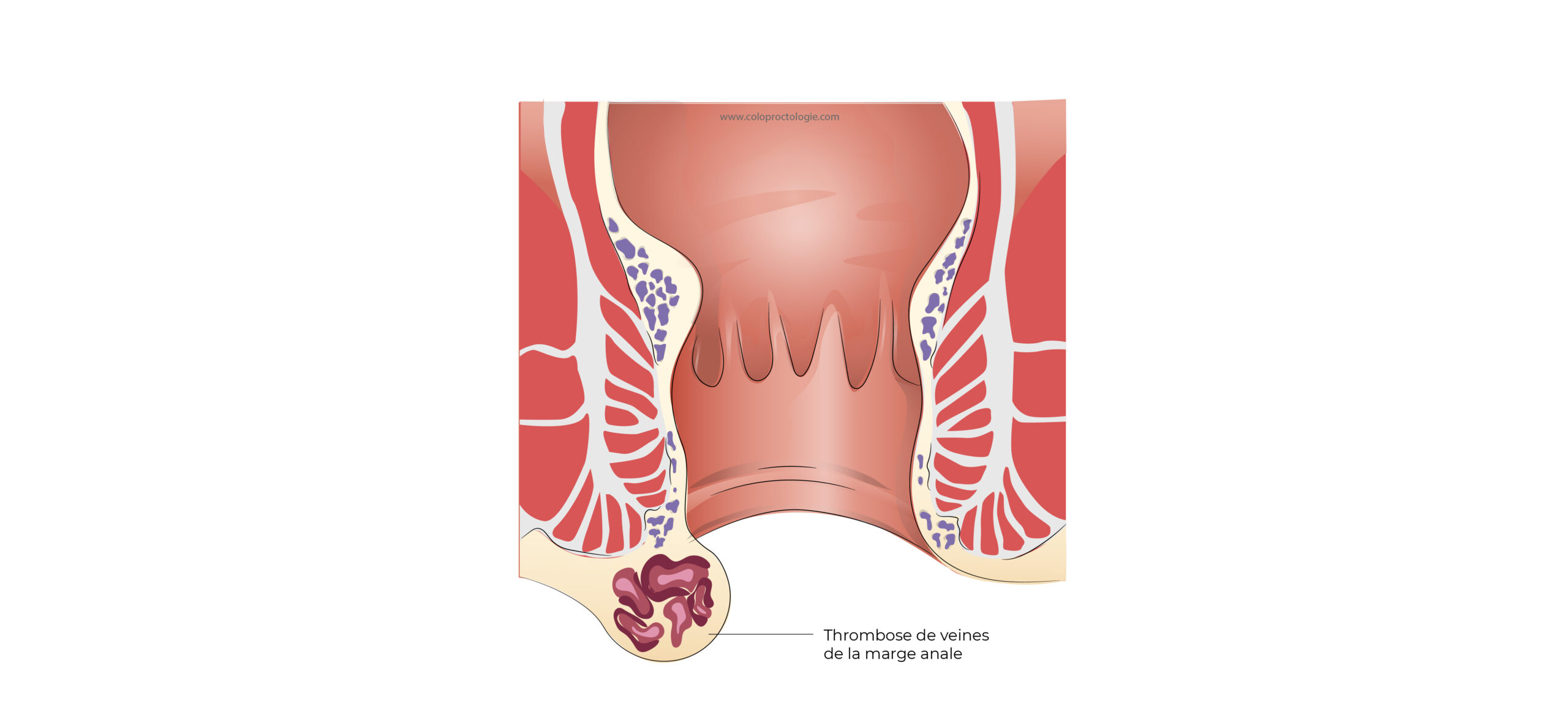 https://coloproctologie.com/wp-content/uploads/2022/03/Hémorroïde-23-scaled.jpg