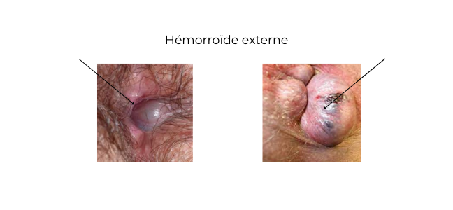 https://coloproctologie.com/wp-content/uploads/2022/03/Hémorroïde-externe.png