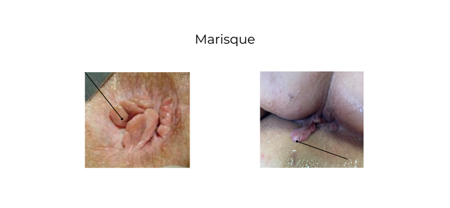 https://coloproctologie.com/wp-content/uploads/2022/03/MARISQUE-2.png