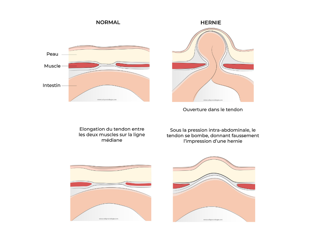 https://coloproctologie.com/wp-content/uploads/2022/03/MARISQUE-500-×-500-px-20-×-15-cm-17.5-×-12.5-cm-648-×-300-px-Graphique.png