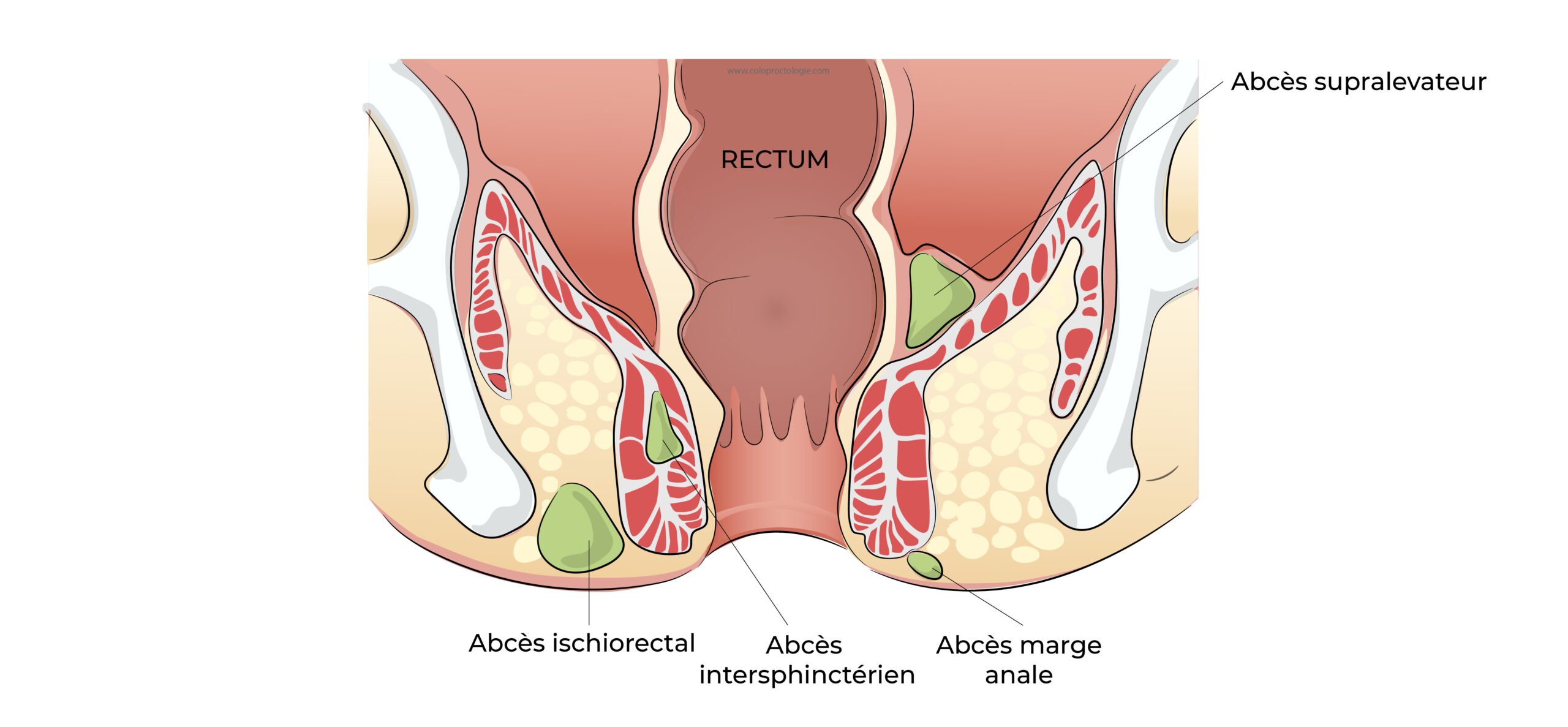 https://coloproctologie.com/wp-content/uploads/2022/04/Abcès-anal-16-scaled.jpeg