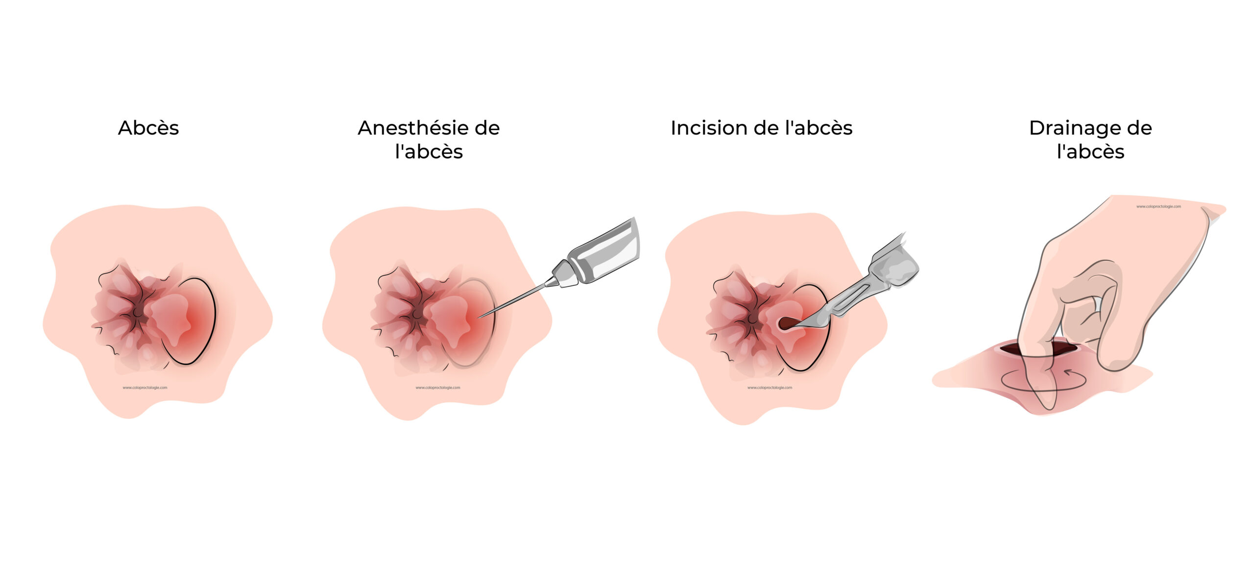 https://coloproctologie.com/wp-content/uploads/2022/04/Abcès-anal-17-scaled.jpeg