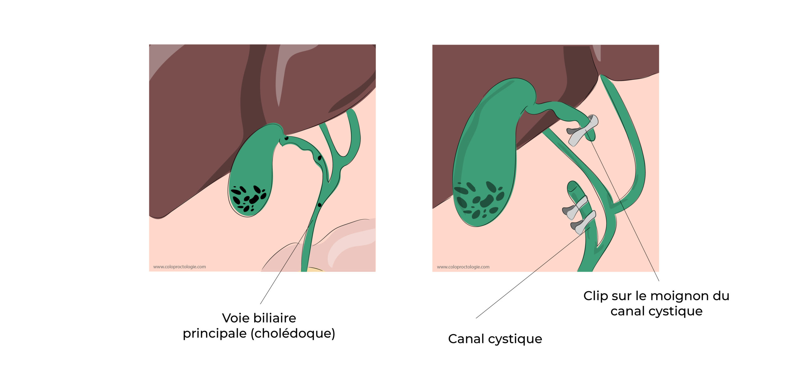 https://coloproctologie.com/wp-content/uploads/2022/04/Calculs-de-la-vésicule-biliaire-11-scaled.jpeg