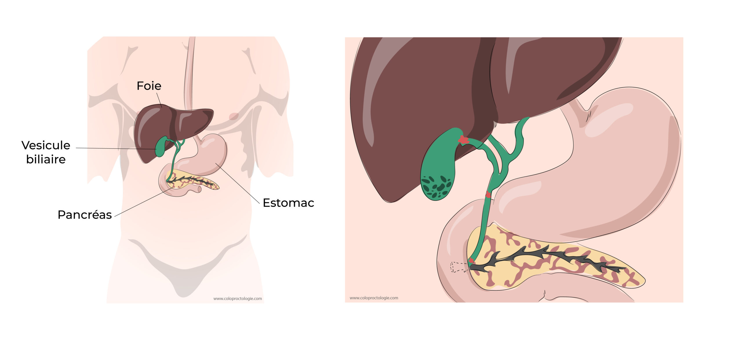 https://coloproctologie.com/wp-content/uploads/2022/04/Calculs-de-la-vésicule-biliaire-15-scaled.jpeg