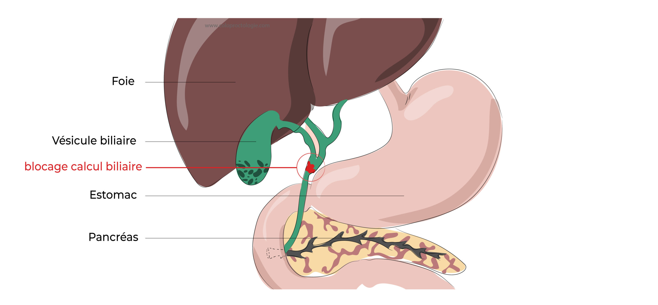 https://coloproctologie.com/wp-content/uploads/2022/04/Calculs-de-la-vésicule-biliaire-17-2-scaled.jpeg