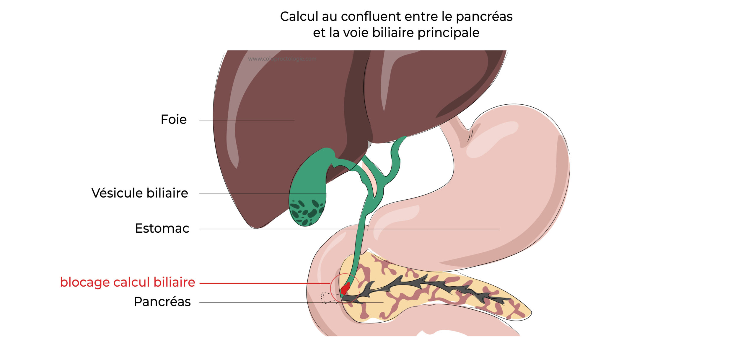 https://coloproctologie.com/wp-content/uploads/2022/04/Calculs-de-la-vésicule-biliaire-18-2-scaled.jpeg