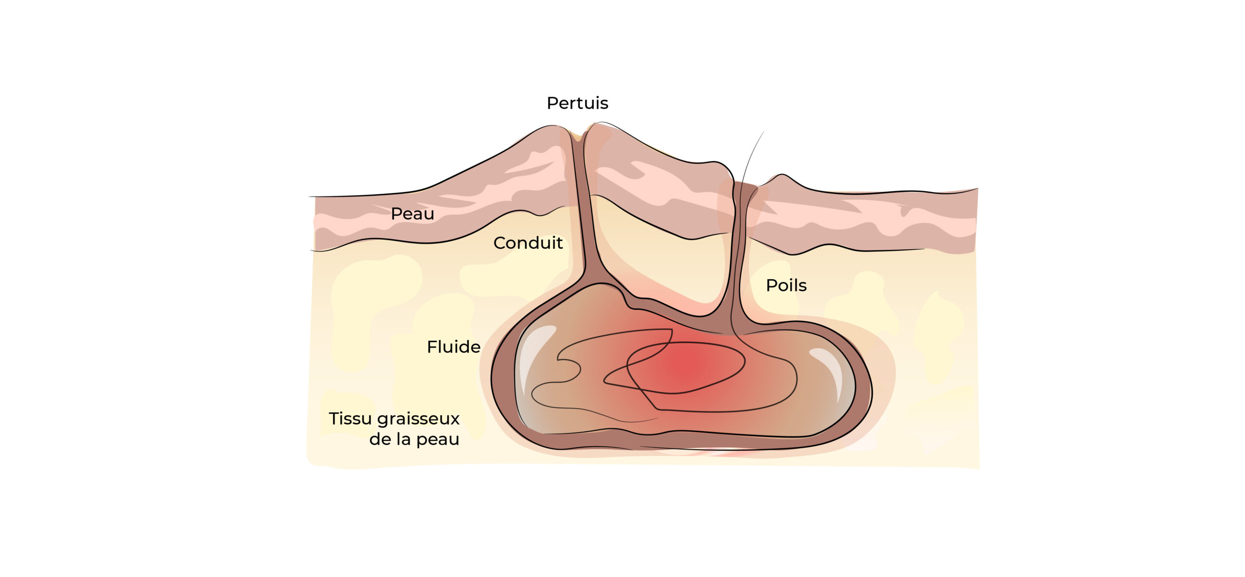 https://coloproctologie.com/wp-content/uploads/2022/04/Kyste-Pilonidale-Illustrations-27-scaled.jpeg