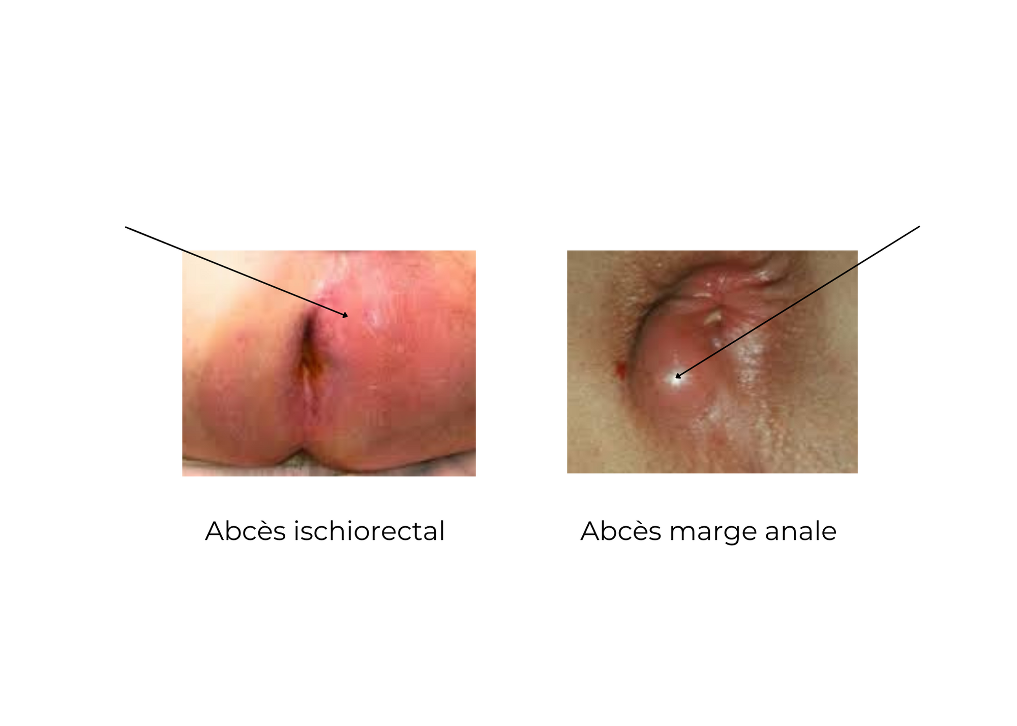 https://coloproctologie.com/wp-content/uploads/2022/04/MARISQUE-500-×-500-px-20-×-15-cm-17.5-×-12.5-cm.png