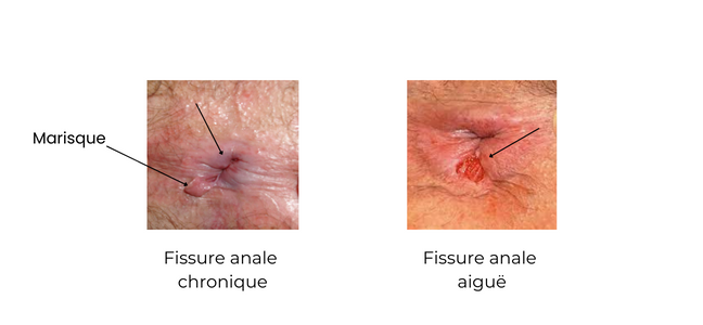 Fissure anale - Coloproctologie
