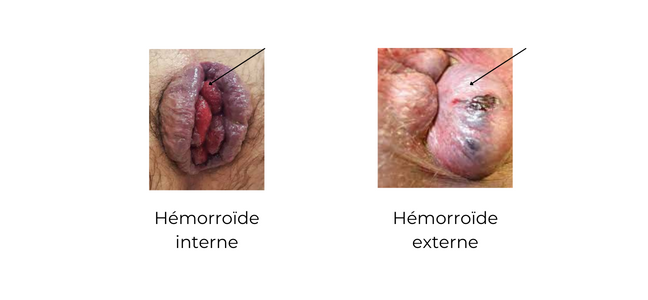 Hémorroïdes lors de la grossesse et après l'accouchement - Coloproctologie