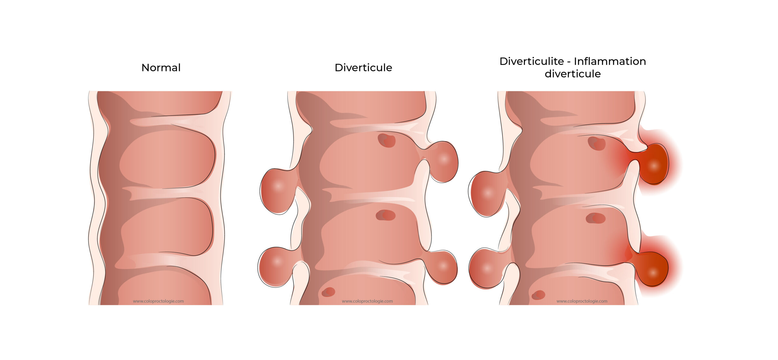 https://coloproctologie.com/wp-content/uploads/2022/05/Diverticulite-aigue-18-scaled.jpg