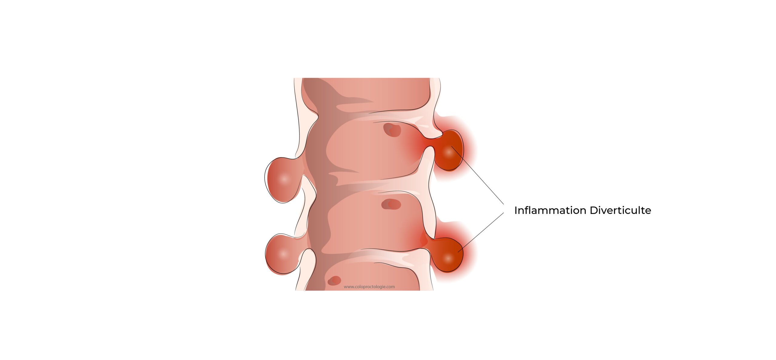 https://coloproctologie.com/wp-content/uploads/2022/05/Diverticulite-aigue-19-scaled.jpg