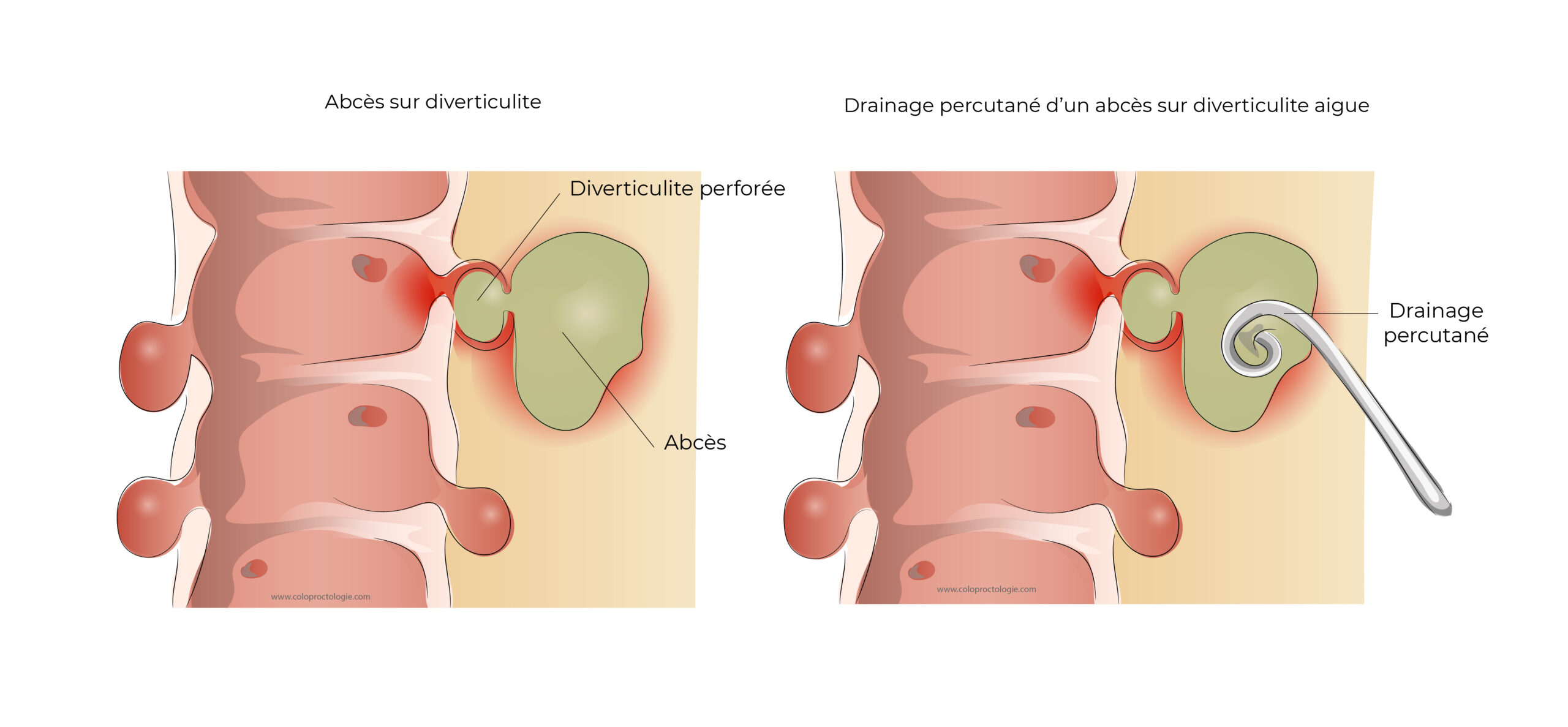 https://coloproctologie.com/wp-content/uploads/2022/05/Diverticulite-aigue-21-scaled.jpg