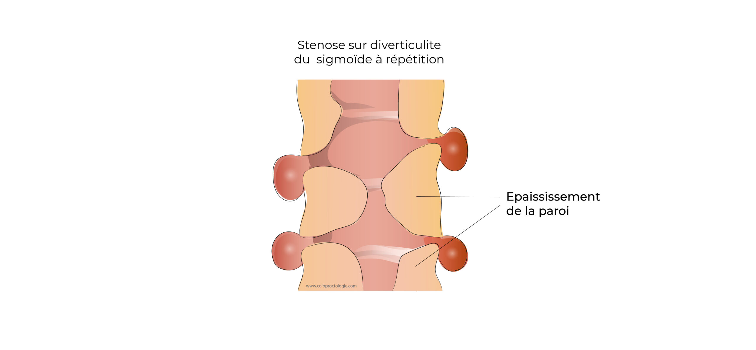 https://coloproctologie.com/wp-content/uploads/2022/05/Diverticulite-aigue-22-scaled.jpg