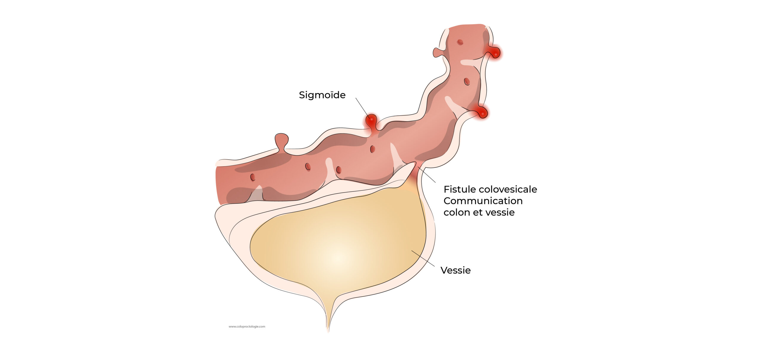 https://coloproctologie.com/wp-content/uploads/2022/05/Diverticulite-aigue-23-scaled.jpg