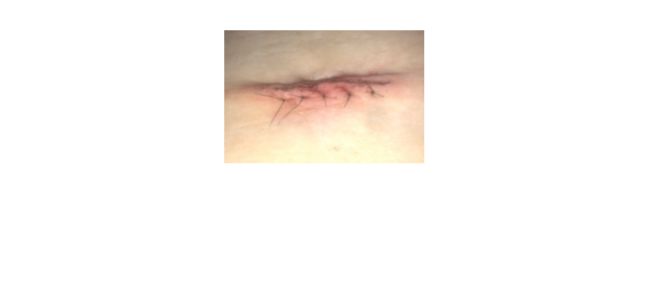 https://coloproctologie.com/wp-content/uploads/2022/05/Suture-externe-avec-fil-non-résorbable-et-noeuds-externe-à-la-peau-1-1.jpg