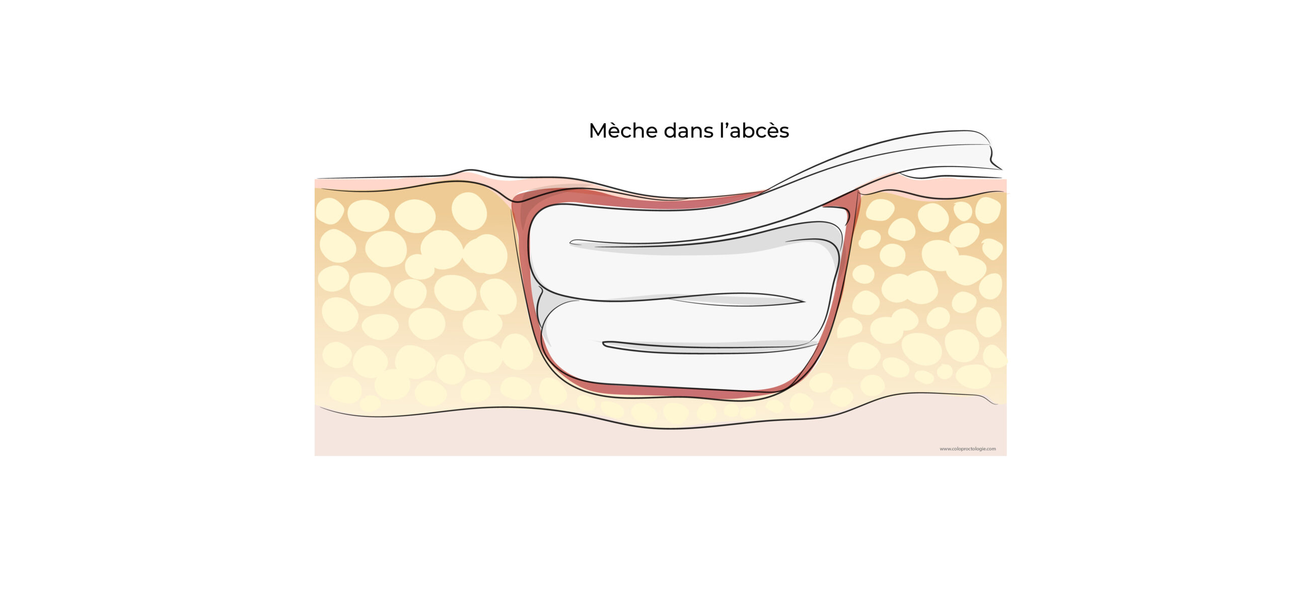 https://coloproctologie.com/wp-content/uploads/2022/06/Abcès-anal-19-scaled.jpeg