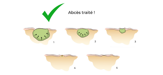 https://coloproctologie.com/wp-content/uploads/2022/06/Abcès-traité.png