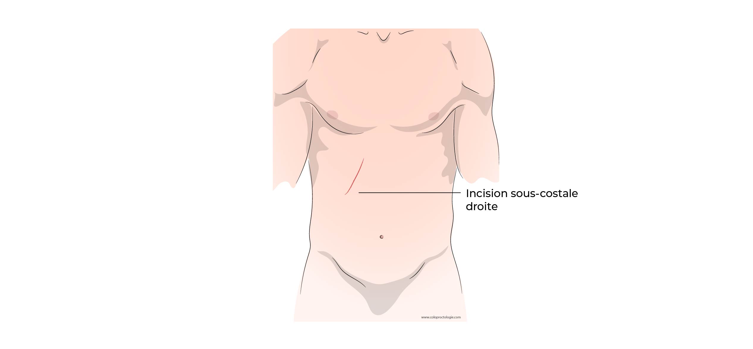 https://coloproctologie.com/wp-content/uploads/2022/06/Calculs-de-la-vesicule-biliaire-1-39.jpg