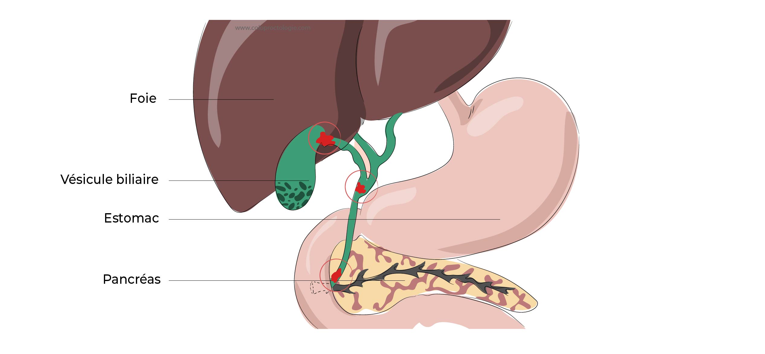 https://coloproctologie.com/wp-content/uploads/2022/06/Calculs-de-la-vesicule-biliaire-1-41.jpg