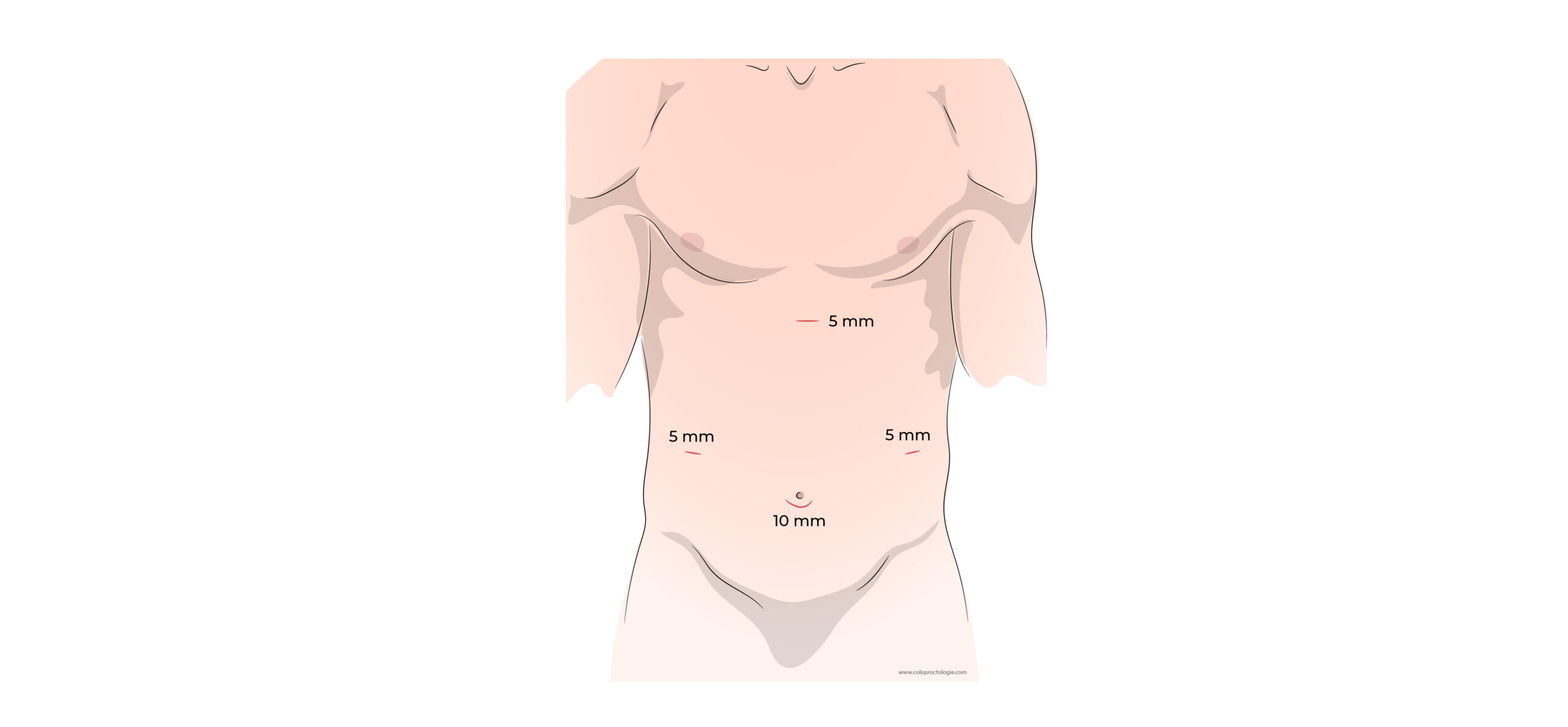 https://coloproctologie.com/wp-content/uploads/2022/06/Calculs-de-la-vésicule-biliaire-20-1-scaled.jpeg