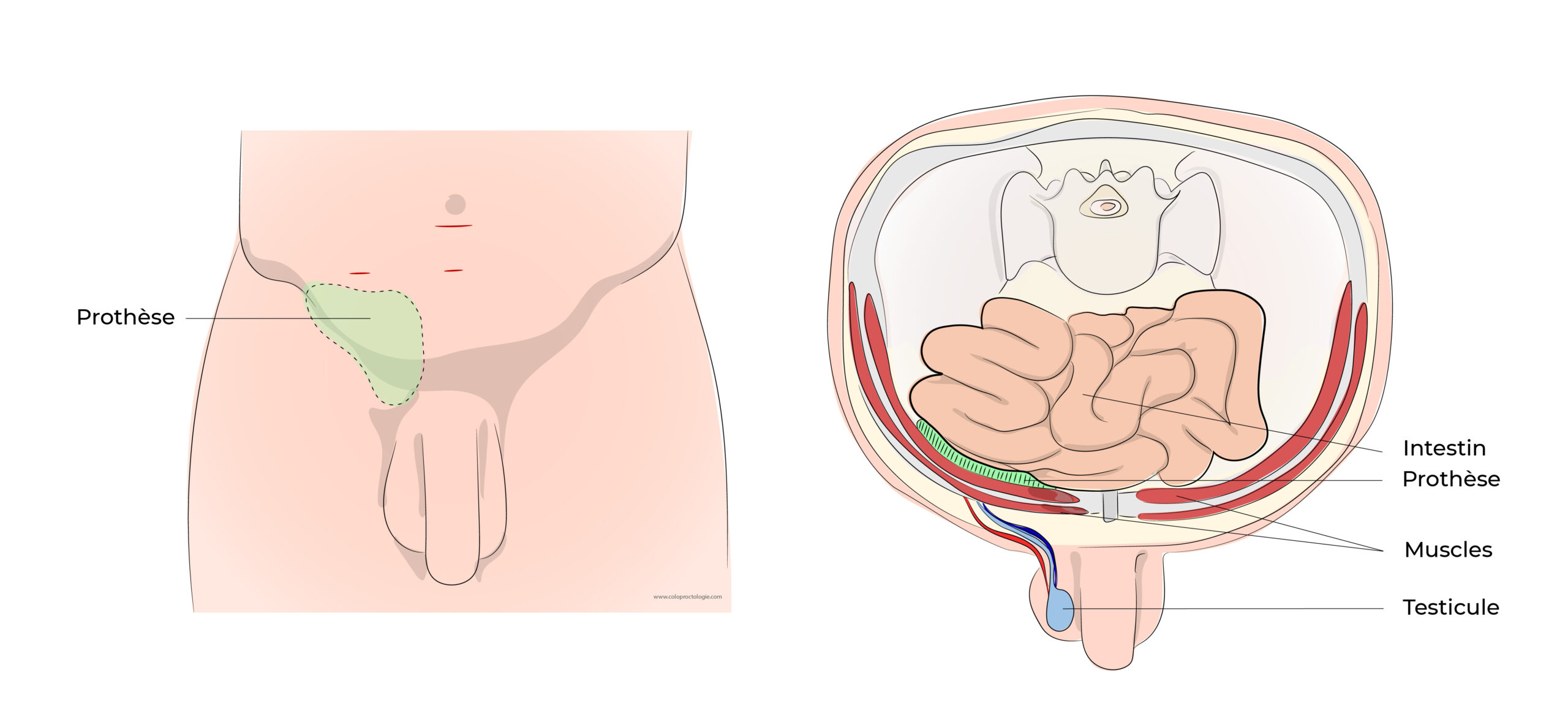 https://coloproctologie.com/wp-content/uploads/2022/06/Hernie-Inguinales-Illustrations-20-scaled.jpeg