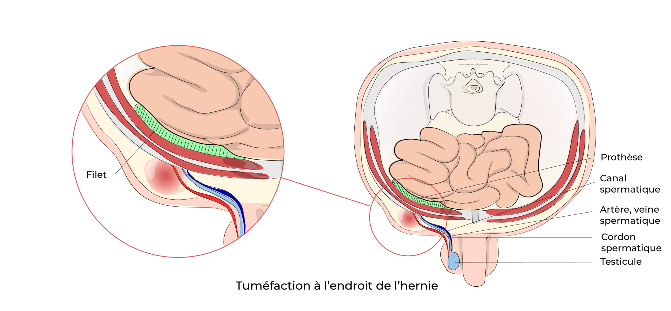 https://coloproctologie.com/wp-content/uploads/2022/06/Hernie-Inguinales-Illustrations-27-scaled.jpeg