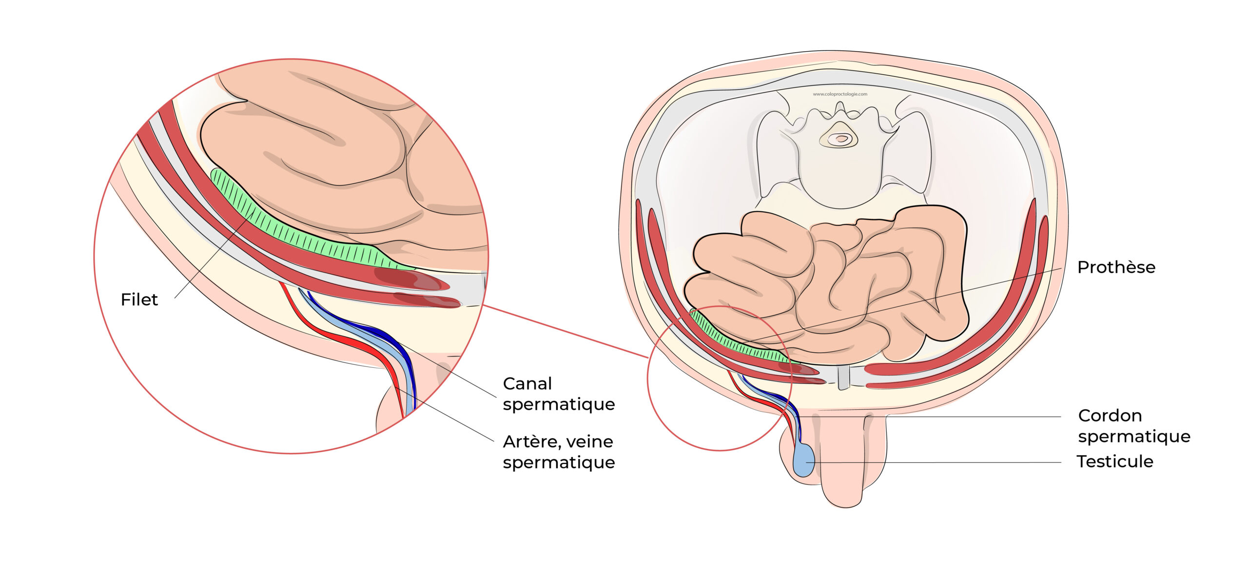 https://coloproctologie.com/wp-content/uploads/2022/06/Hernie-Inguinales-Illustrations-28-scaled.jpg