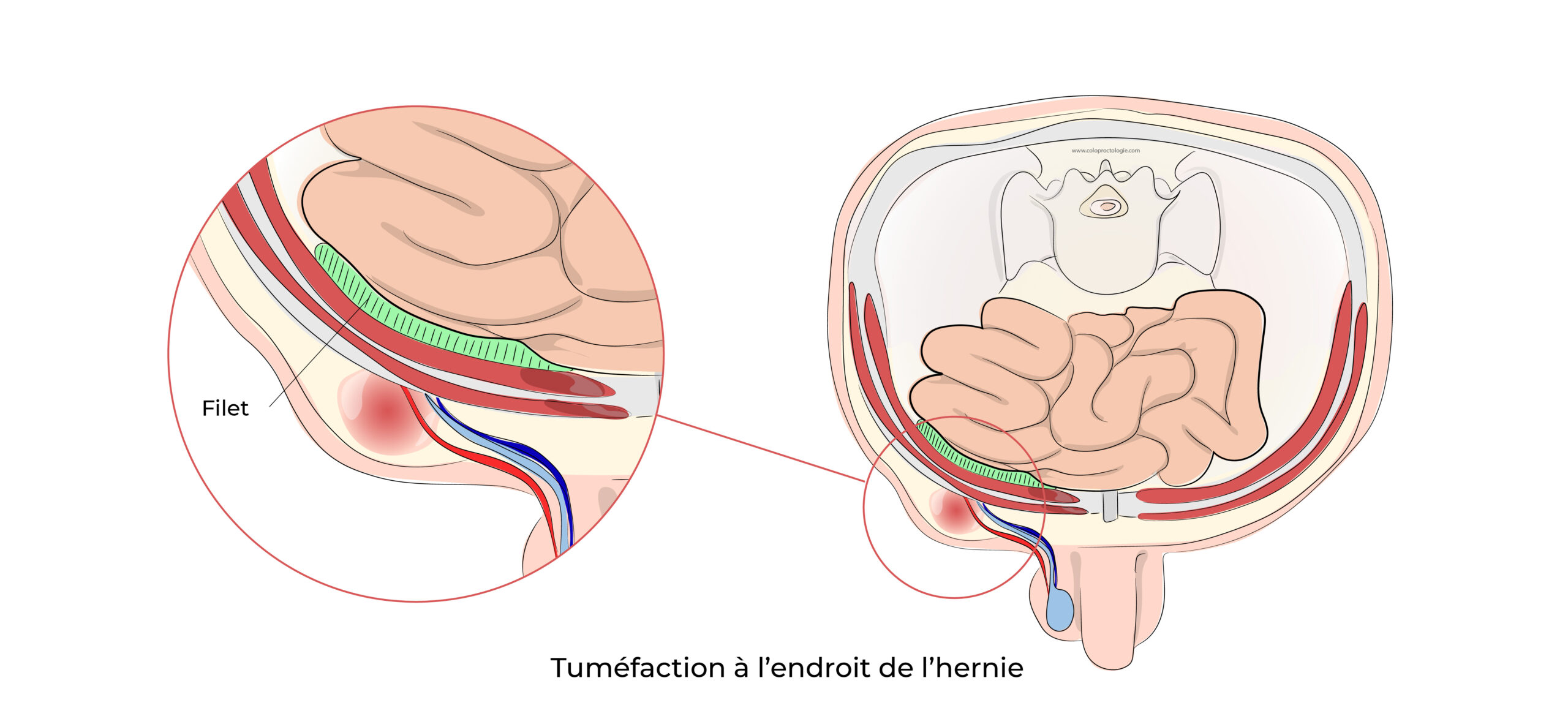 https://coloproctologie.com/wp-content/uploads/2022/06/Hernie-Inguinales-Illustrations-scaled.jpeg