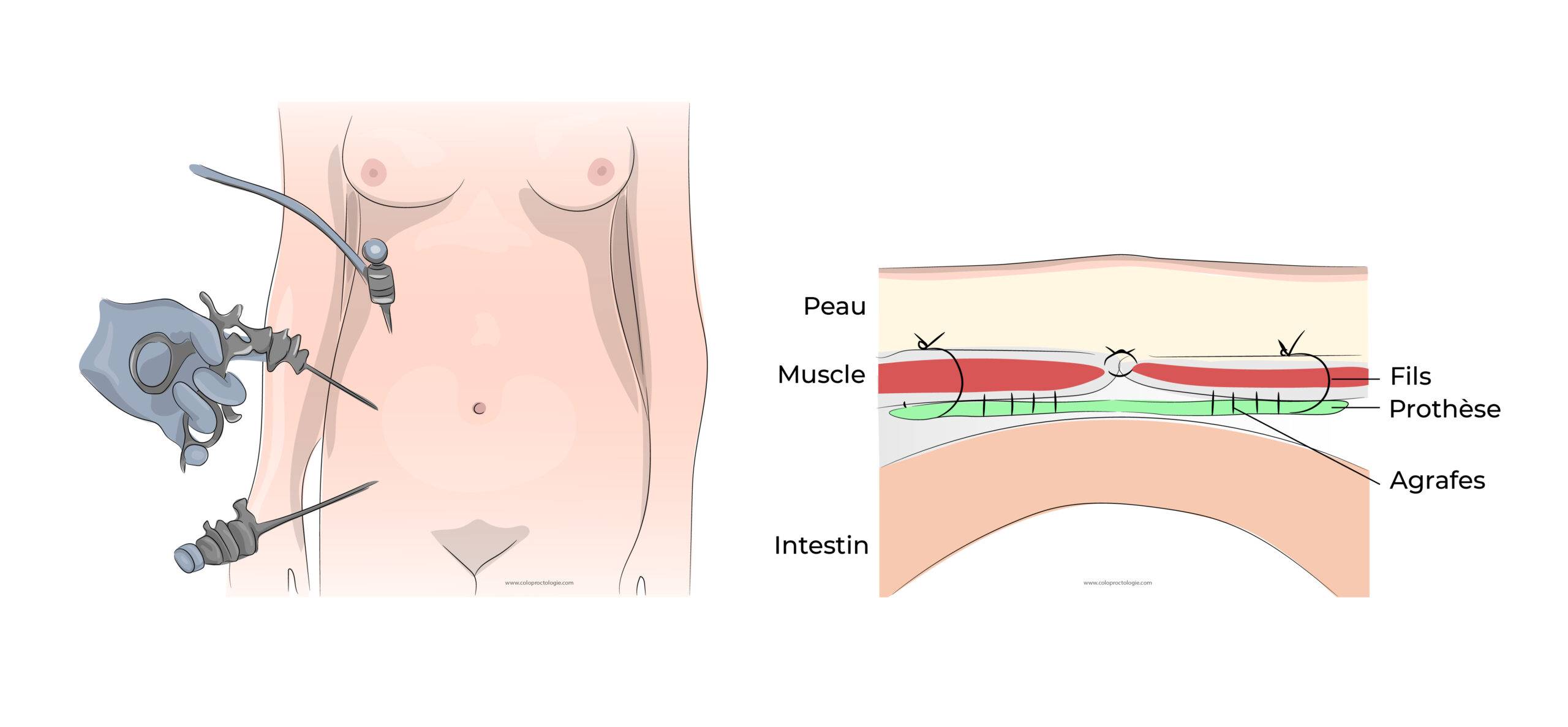 https://coloproctologie.com/wp-content/uploads/2022/06/Hernie-Ombilicale-Illustrations-14-1-scaled.jpeg