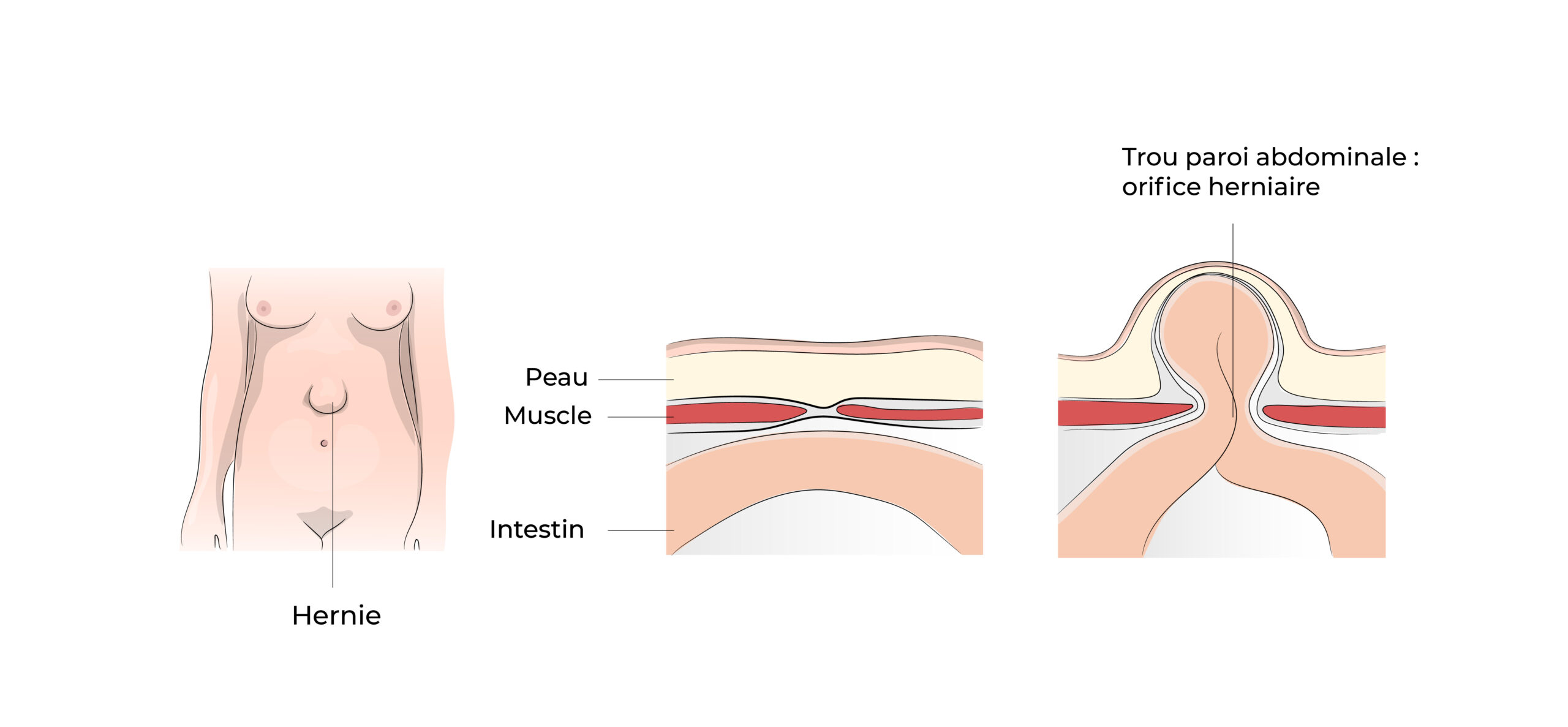 https://coloproctologie.com/wp-content/uploads/2022/06/Hernie-Ombilicale-Illustrations-14-scaled.jpeg