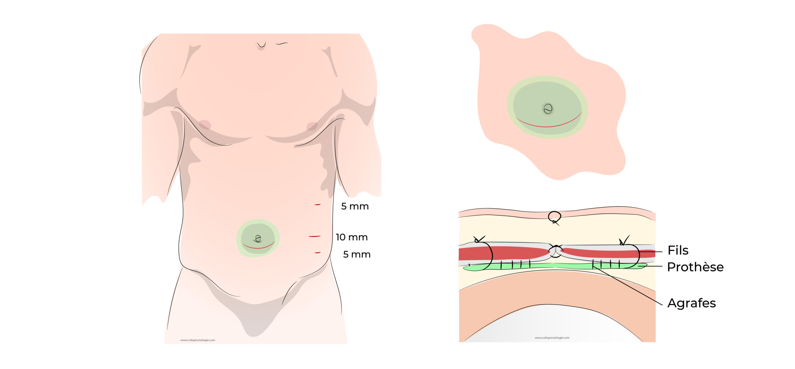 https://coloproctologie.com/wp-content/uploads/2022/06/Hernie-Ombilicale-Illustrations-17-2-scaled.jpeg