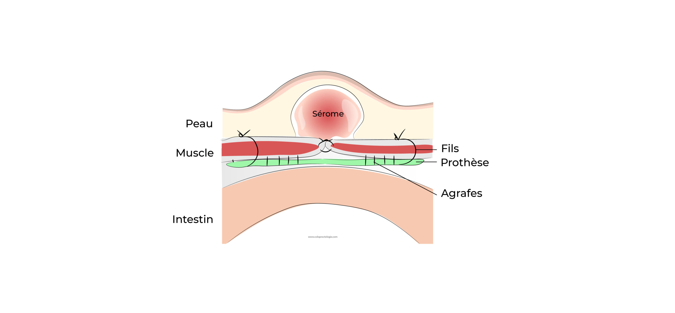 https://coloproctologie.com/wp-content/uploads/2022/06/Hernie-Ombilicale-Illustrations-26-scaled.jpeg