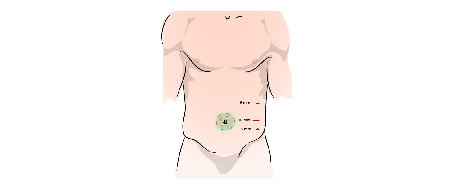 https://coloproctologie.com/wp-content/uploads/2022/06/Hernie-Ombilicale-Illustrations-_Vignette-copy-3.jpeg