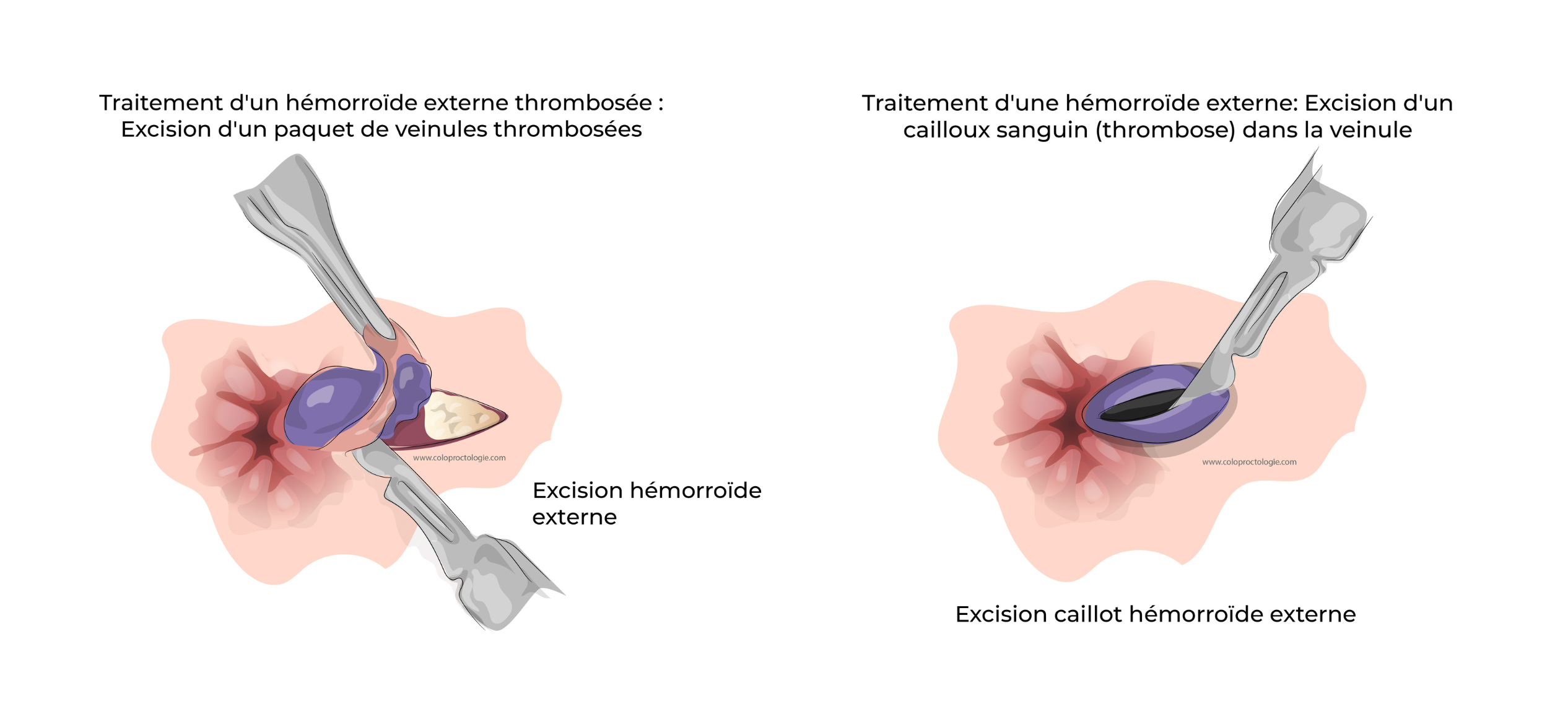 https://coloproctologie.com/wp-content/uploads/2022/06/Hémorroide-externe.png