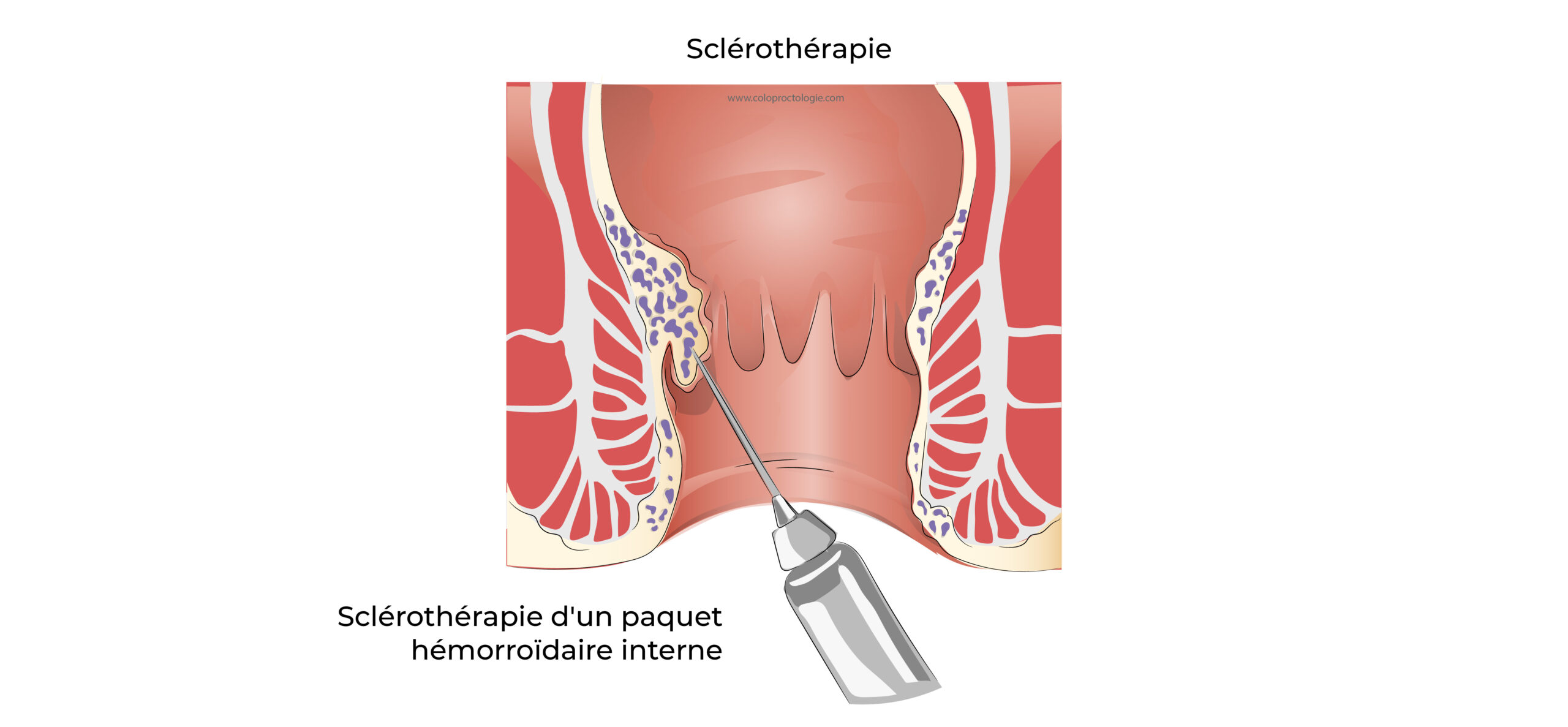 https://coloproctologie.com/wp-content/uploads/2022/06/Hémorroïde-24-1-scaled.jpeg