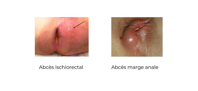 https://coloproctologie.com/wp-content/uploads/2022/06/MARISQUE-500-×-500-px-20-×-15-cm-17.5-×-12.5-cm-648-×-300-px-1.jpg