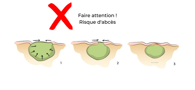 https://coloproctologie.com/wp-content/uploads/2022/06/Risque-abcès.png